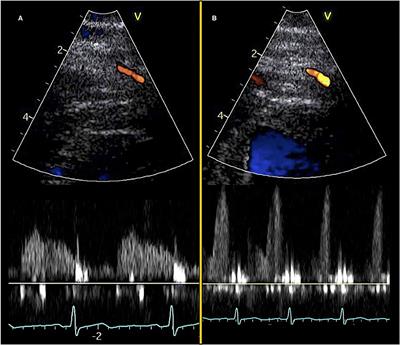 Doppler Echocardiography Assessment of Coronary Microvascular Function in Patients With Angina and No Obstructive Coronary Artery Disease